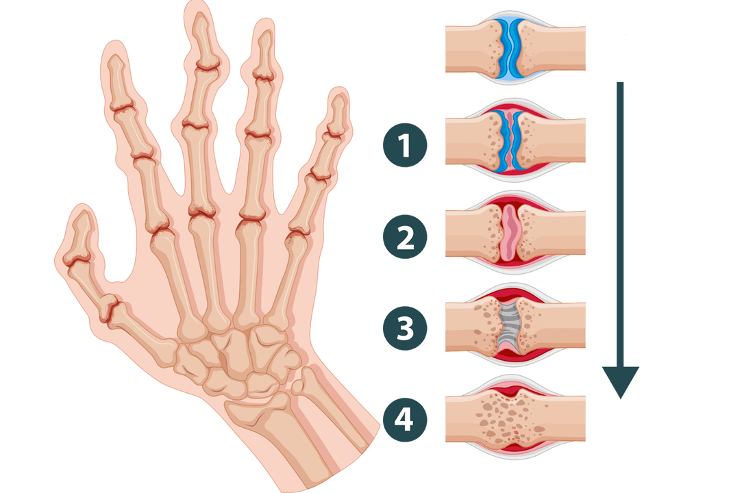Etapy vývoja artritídy - zápalové poškodenie kĺbov