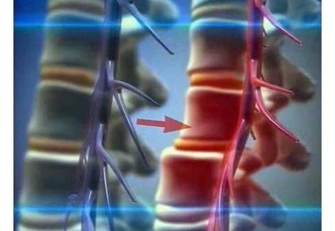 Kompresia nervových zakončení pri bedrovej osteochondróze