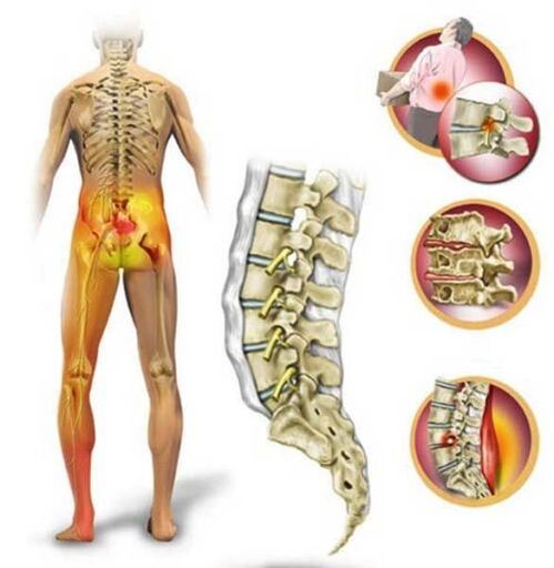 Osteochondróza bedrovej chrbtice, ktorá spôsobuje bolesť v dolnej časti chrbta