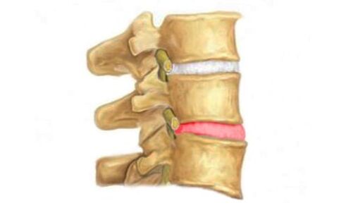 Výčnelok medzistavcového disku chrbtice - znak osteochondrózy