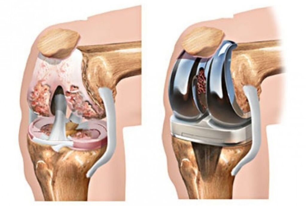 artroplastika kolena pri artróze