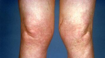 deformácia kolenných kĺbov s artrózou