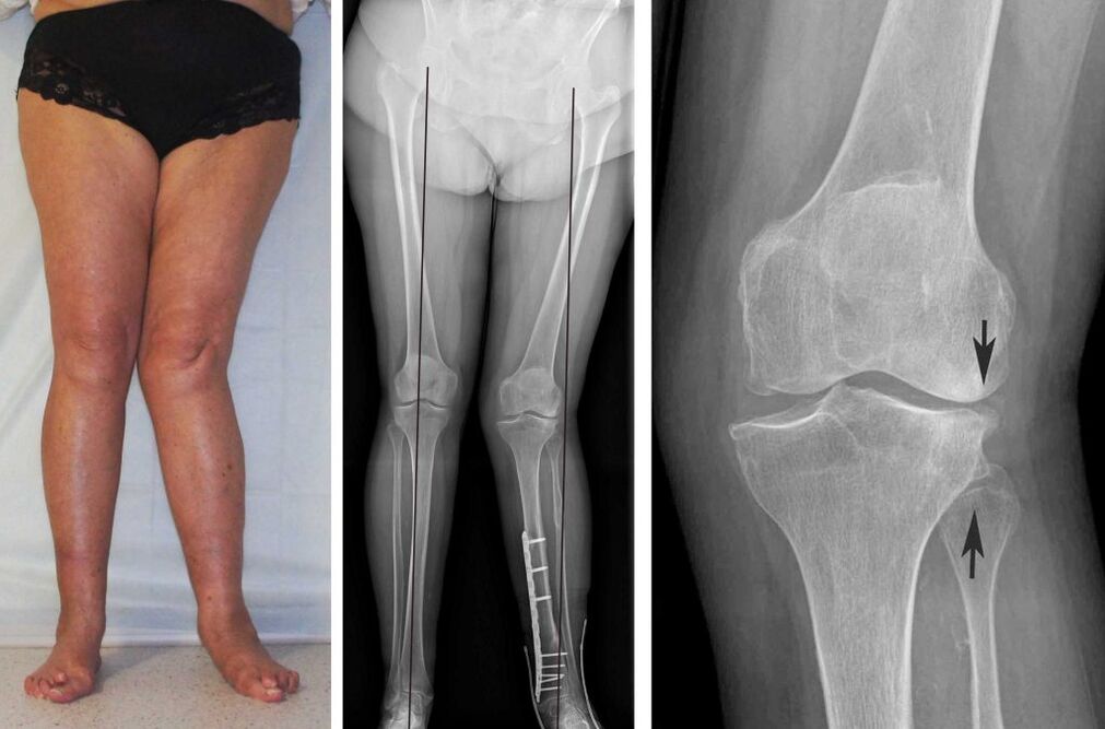 klinický obraz osteoartrózy kolena