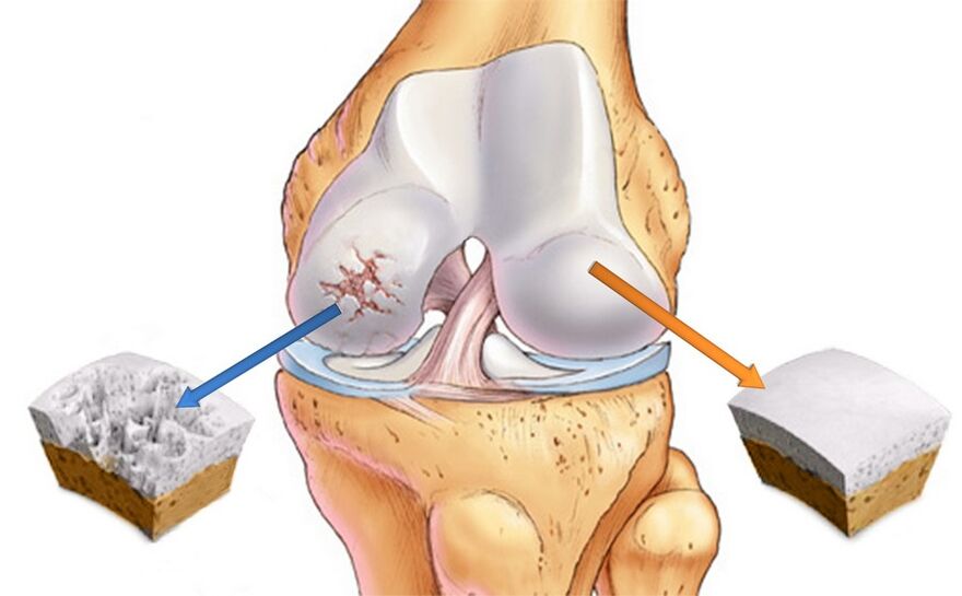 Zdravý kolenný kĺb (vpravo) a postihnutý artrózou (vľavo)